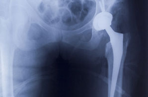 Solutions for Artificial Hip Implant Prosthesis Testing