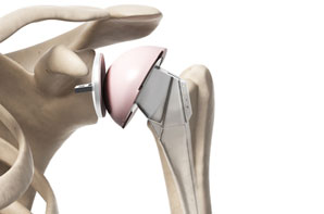 Solutions for Artificial Shoulder Implant Prosthesis Testing