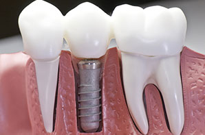 Solutions for Dental Implant Testing