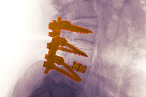 Testing Solutions for Spinal Implant Construct Testing